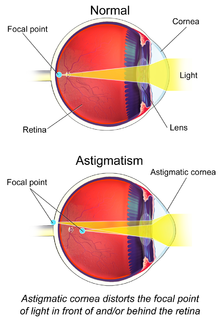 Astigmatism eye | 2